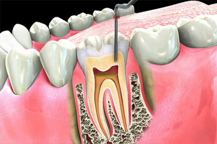 Benefits of Root Canal Treatment Over Tooth Extraction