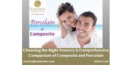 Choosing the Right Veneers: A Comprehensive Comparison of Composite and Porcelain