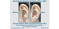 Earlobe Repair With Injectable Dermal Filler Available at BrightSmile Dental & Aesthetic Clinic NW3
