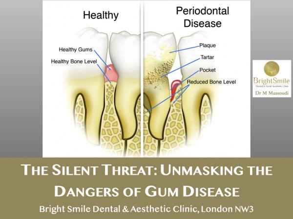 gum disease_aug 2023