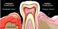How P. gingivalis causes chronic inflammation in blood vessels