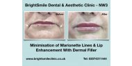 Minimisation of Marionette Lines & Lip Enhancement With Dermal Filler available at BrightSmile Clinic - NW3