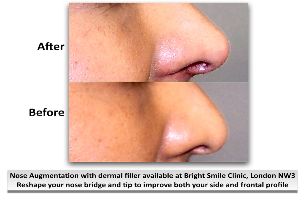 Non-Surgical Nose Filler Augmentation Available at Bright Smile Clinic, London NW3 