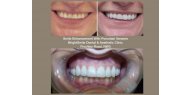 Smile Enhancement With Porcelain Veneers at BrightSmile Clinic, Finchley Road, NW3