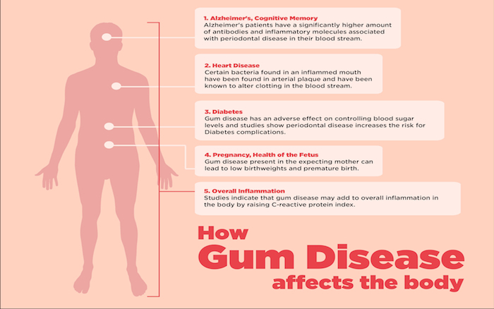 Taking care of your gums by regular dental visits could help hold heart disease at bay