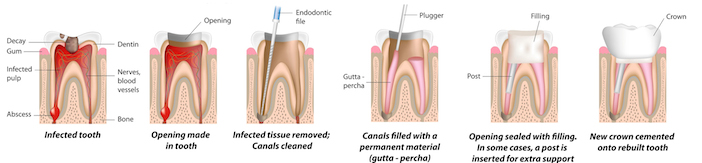 What is a Root Canal? What is Endodontics?
