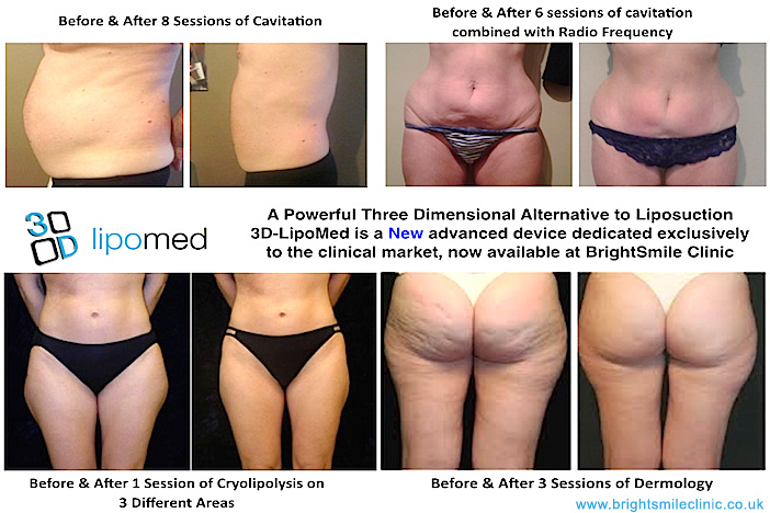 3D-Lipomed before and after photo showing significant fat loss and cellulite reduction