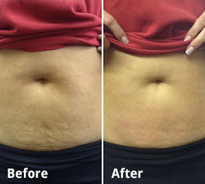 3D Lipo before and after photo