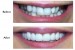 Pictures of a smile enhancement using veneers carried out at our Finchley Road, NW3 Dental Practice