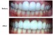 Pictures of a smile enhancement by porcelain bridge done at our Finchley Road, NW3 dental practice
