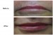 Lip Enhancement using Juvederm (dermal filler) done at our NW3, Finchley Road, dental clinic