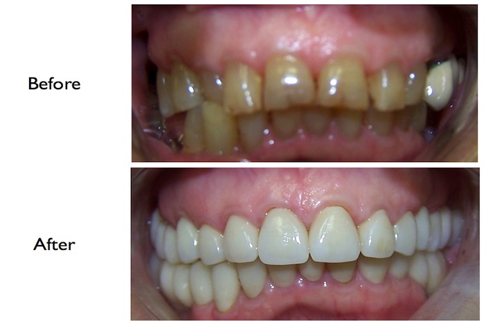 Full mouth reconstruction using crowns & veneers done at our NW3, Finchley Road dental clinic