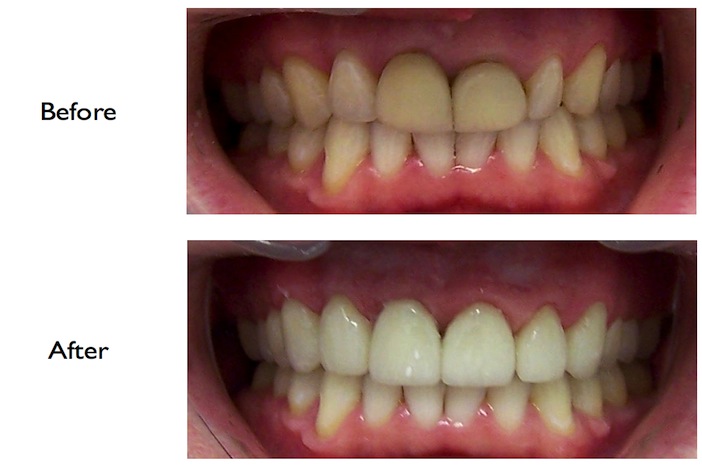 Full mouth reconstruction using crowns & veneers done at our NW3, Finchley Road dental clinic