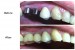 Pictures of a pre-molar & molar implant done at our NW3, Finchley Road dental clinic