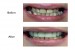 Reconstruction of upper teeth with crowns & bridges performed at our Finchley Road NW3 Dental Clinic