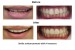 Smile Enhancement & Gap Closure Using 4 Veneers done at our Finchley Rd. Dental Clinic