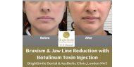 Bruxism & Jaw Line Reduction with Botulinum toxin Injection, Bright Smile Clinic, London NW3