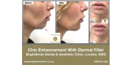 Chin Enhancement with Dermal Filler - BrightSmile Dental & Aesthetic Clinic, London NW3