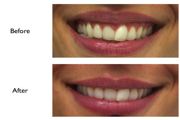 Gummy smile correction using Botox performed at BrightSmile Dental Practice