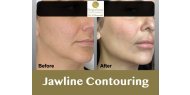 Jawline Contouring with dermal filler - BrightSmile Clinic NW3