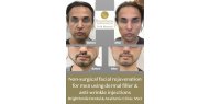Non-surgical facial rejuvenation for men using dermal filler and anti-wrinkle injections