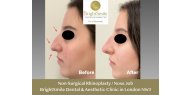 Non-Surgical Rhinoplasty / Nose Job - Bright Smile Aesthetic & Dental Clinic - NW3 - London