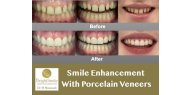 Smile Enhancement With Porcelain Veneers - BrightSmile Dental & Aesthetic Clinic London NW3
