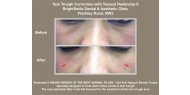 Tear Trough Treatment with Redensity-II Available at BrightSmile Clinic, NW3