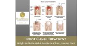 Why Saving Your Natural Teeth Matters - Benefits of Root Canal Treatment